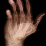 Nuove scoperte per la cura dell'artrite reumatoide