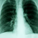 Trovato il sistema per diagnosticare il cancro al polmone attraverso il respiro del paziente