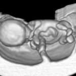 Cellule staminali, in vigore la nuova ordinanza sul cordone ombelicale