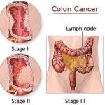 Al via la sperimentazione sui pazienti del vaccino Pitt contro il tumore al colon