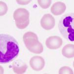 Identificato il ruolo delle cellule immuni nella fibrosi cistica