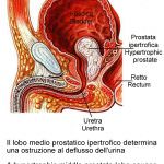 Omega-3 contro il cancro alla prostata