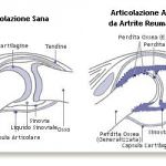 Un deficit di vitamina D favorisce l'artrite