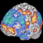 Una proteina anti artrite reumatoide contrasta l'Alzheimer