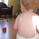 Sanità in Lombardia - Un opuscolo informativo aiuterà a conoscere e prevenire le malattie infettive infantili