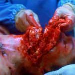 Usa, schiaffo al virus Ebola: da oggi è più facile combatterlo