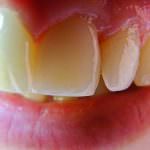 Lo stress danneggia denti e gengive