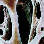 Troppo colesterolo porta ossa fragili