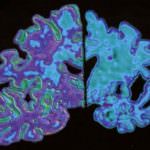 Alzheimer: tre geni fanno la differenza