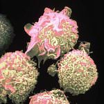 Leucemia: in Italia si cura senza chemioterapia