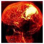 Il rischio ictus triplica per un ora dopo aver assunto alcolici