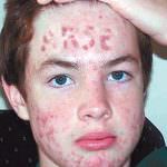 Acne via in tre giorni con il cerotto hi-tech