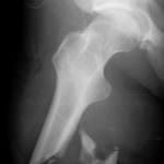 Il diabete danneggia le ossa