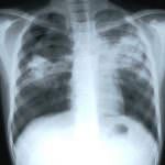 Reggio Emilia: tubercolosi a scuola, partiti i controlli