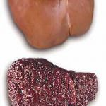 Epatite B: una proteina anomala favorisce l'infezione