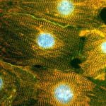 Cellule staminali per fermare la distrofia muscolare di Duchenne