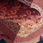 Colesterolo: così attacca le arterie