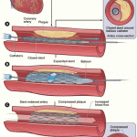 Gran Bretagna. Un'arteria artificiale per la salute del cuore