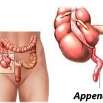 L'appendicite è causata da un virus