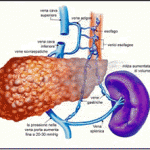 Obesità: i chili in più stimolano il cancro al fegato