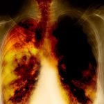 Cancro ai polmoni: smettere di fumare fa vivere più a lungo