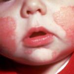 Minerali e vitamina E contro l'eczema nei bambini