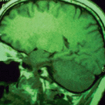 Sclerosi multipla: primi risultati dei test CCSVI