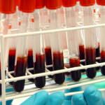 La proteina fibrinogeno aumenta di 7 volte il rischio per il cuore