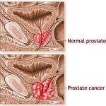 Cancro alla prostata. Un cerotto alla nitroglicerina per bloccarne lo sviluppo
