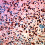 La sclerosi multipla è forse causata da un batterio