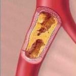 Ridurre il grasso nel sangue per curare obesità, cuore e diabete