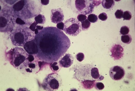 Un test per individuare i tumori con 6 anni di anticipo