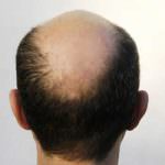 La calvizie protegge dal cancro alla prostata