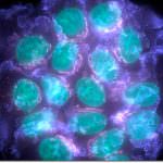 Crioblazione per curare il cancro al seno