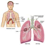 Tumore ai polmoni: i fumatori hanno un rischio 60 volte superiore