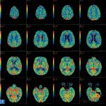 SLA, una proteina spazzina elimina le tossine