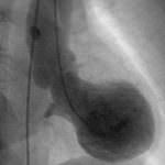 Cuore: così agisce la sindrome di Tako-Tsubo