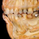 Cellule staminali per ricreare le ossa della bocca