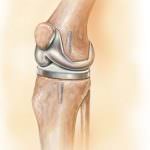 Cellule staminali per riparare le articolazioni