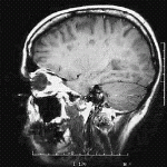 Sclerosi multipla, l'avviso di Zamboni: "Risposte in tempi brevi o aumenta il rischio di speculazioni"