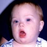 Sindrome di Down, un esame del sangue la scoprirà