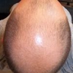 Calvizie a 20 anni, più rischio di cancro alla prostata poi